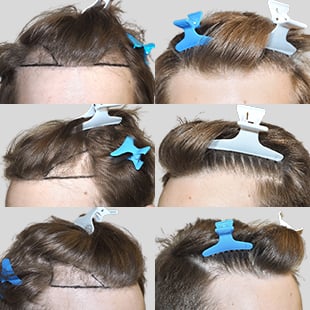 Hair transplant stages: Marked hairline before procedure. Shows hair restoration process. Before shots only.