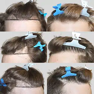 Hair transplant stages: Marked hairline before procedure. Shows hair restoration process. Before shots only.