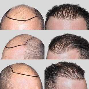Hair transplant before & after: Caucasian male. See natural hair restoration results.