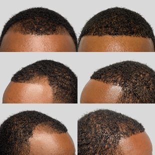 Hair transplant before & after: African American man. Restored hairline, fuller, natural-looking results.