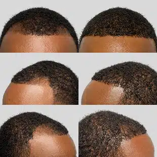 Hair transplant before & after: African American man. Restored hairline, fuller, natural-looking results.