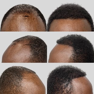 Hair transplant before & after: African American man. See natural hair restoration results.