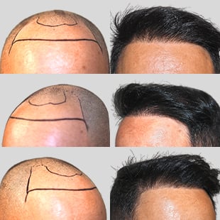 Hair transplant before & after: See real hair restoration results. Three patient comparisons showcasing procedure effectiveness.