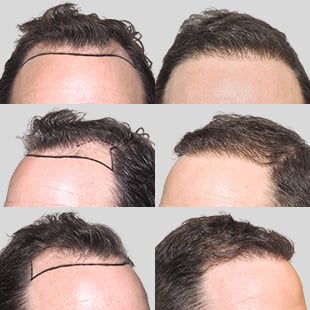 Hair transplant before & after. Caucasian man's hair restoration results. See the difference!