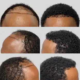 Hair transplant before & after: African American man. Restored hairline, fuller, textured hair. Hair restoration results.