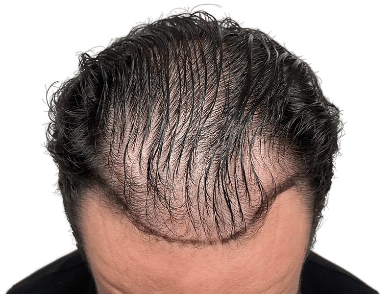 Hair transplant result: Fuller, defined hairline. Before & after hair restoration showcasing improved density. Dark hair, Caucasian male.