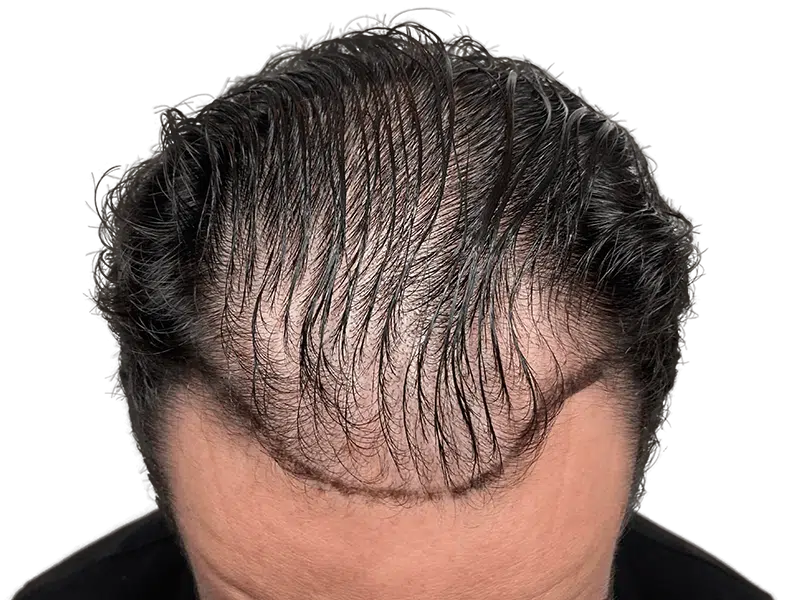 Hair transplant result: Fuller, defined hairline. Before & after hair restoration showcasing improved density. Dark hair, Caucasian male.