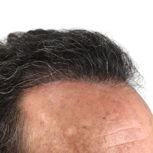 Before After 3