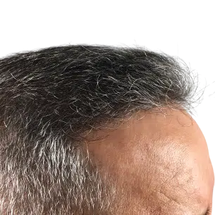 Before After 3