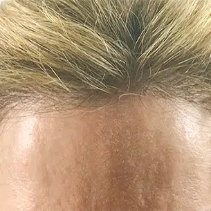 Before After 1