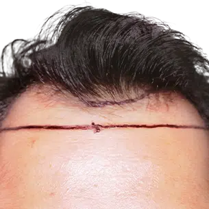 Before After 0