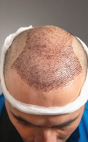 Patient immediately after a large-session FUE hair transplant