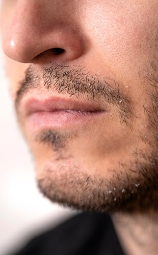 Close-up of beard hair, a common donor area for body hair transplants