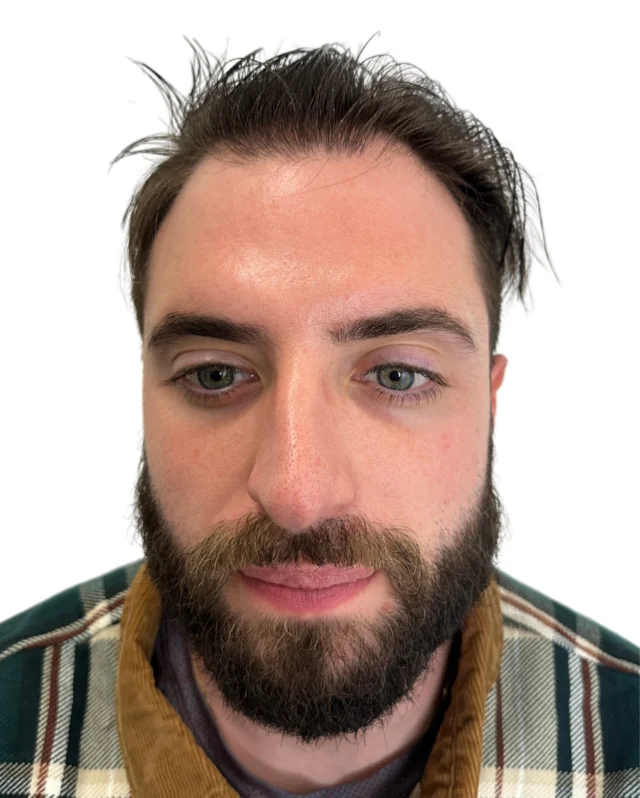 Swipe left to see this doctor's amazing hair transplant results after 6 months!