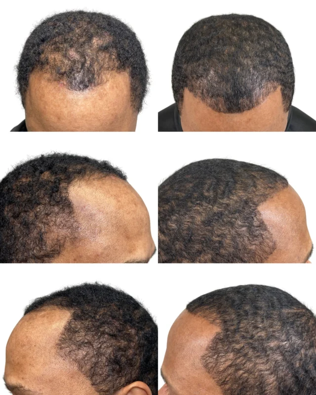 Hair transplants for African American textured hair are not one-size-fits-all. Curl pattern, density, and the way the hair grows beneath the skin all impact the success of the procedure. While curls are visible on the surface, the real challenge lies in the curved follicle deep in the dermis, which makes extraction more complex.

There are two common curl types: the “J” curl and the “C” curl. “J” curls are easier to work with due to their gentler curve. “C” curls, however, bend both above and below the skin, making them harder to harvest without damage. Most standard FUE tools aren’t made for textured hair, so working with a skilled specialist who understands these nuances is key to getting great results.