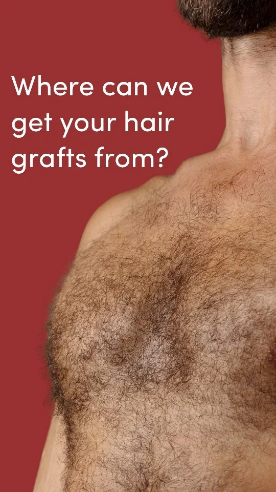 Hair grafts for transplantation can be harvested from various parts of the body, not just the scalp. While the back and sides of the scalp are the most commonly used donor areas due to their dense, permanent hair, other body areas can also serve as donor sources when scalp hair is insufficient. This technique, known as Body Hair Transplantation (BHT), involves harvesting hair from the beard, chest, back, abdomen, arms, or legs. Among these, beard and chest hair are often preferred because of their thicker texture and strong growth characteristics, which make them more compatible with scalp hair. The success of body hair transplantation depends on factors such as hair quality, skin type, and—most importantly—the skill and experience of the surgeon performing the procedure.