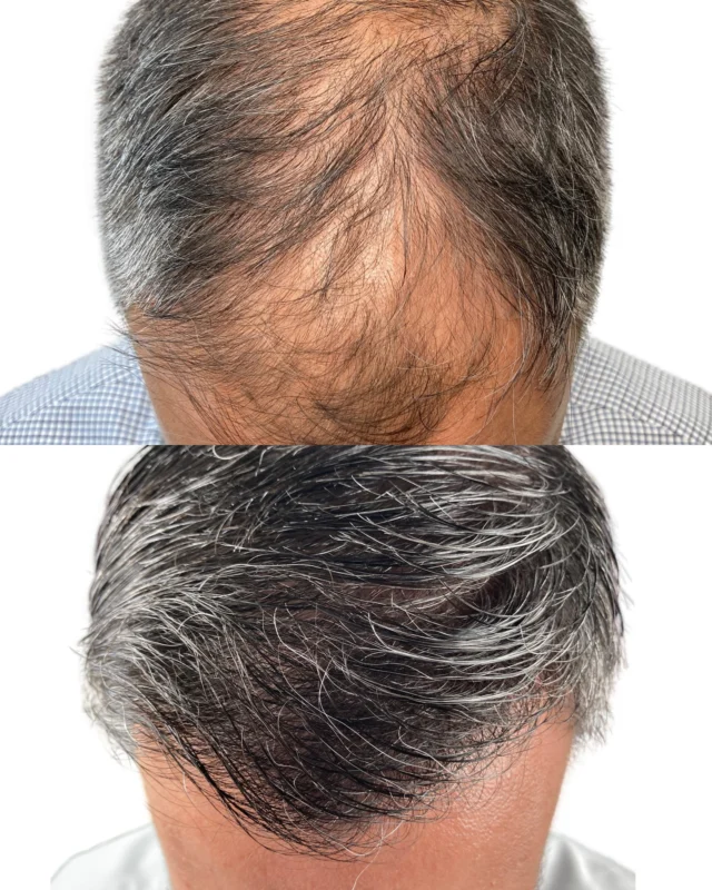 The top view of a hair transplant provides the most revealing and accurate perspective of the procedure's success. From this angle, you can clearly assess the density, coverage, and natural-looking growth pattern of the transplanted hair. It allows you to see how well the new hair blends with your existing hair and whether the overall result looks balanced and realistic. Unlike other angles that may hide imperfections or gaps, the top view shows everything—making it the most honest and informative way to evaluate your results. Whether you're tracking your own progress or reviewing before-and-after photos, the top view tells the full story.