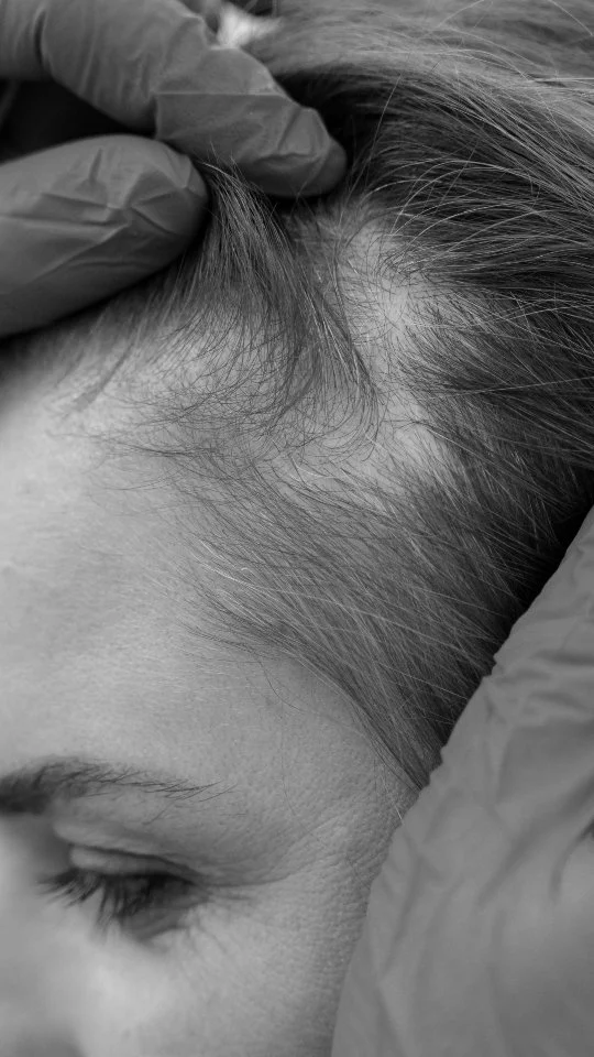 Female hair transplant is a popular solution for women experiencing hair thinning or hair loss, often due to genetics, hormonal changes, or stress. It offers a long-term approach to restoring fuller, natural-looking hair and can have a significant impact on self-esteem and confidence. As awareness grows, more women are exploring this option as a way to regain control over their appearance and feel more like themselves again.