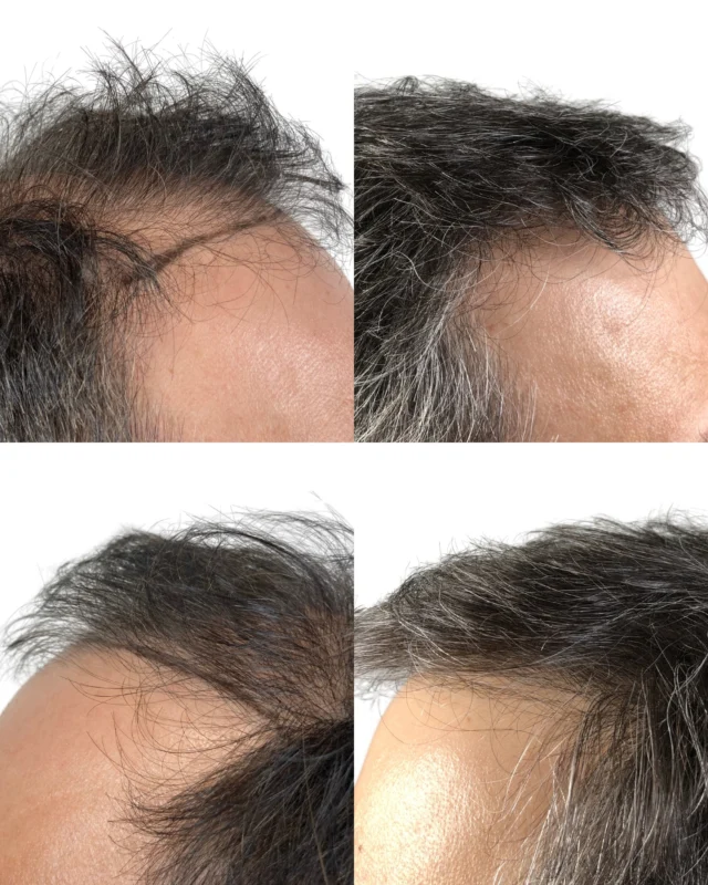 After a hair transplant, hair often looks much fuller and more natural. Thin or balding areas are filled in with healthy, growing hair, creating a thicker and more even appearance. The added volume helps define the hairline and brings balance to the face, making everyday styling easier and more satisfying. This boost in fullness can make a big difference in both appearance and confidence. A hair transplant doesn’t just replace lost hair—it brings back the look of a healthy, fuller head of hair.