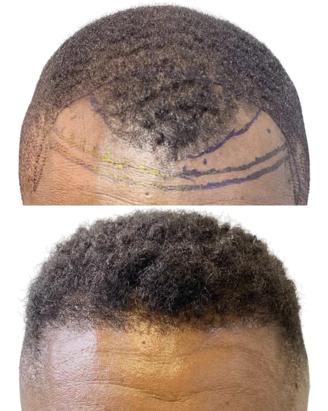 Nothing's better than an attractive hairline for your Friday night activities! #WeDoWhatOthersCant!