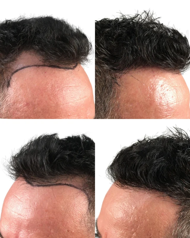 Choosing the right hair transplant doctor is essential for achieving natural-looking results and avoiding complications. Here are the key signs that your hair transplant doctor is the right one for you:

- Certified & Experienced
- Real Results
- Honest & Clear
- Tailored Approach
- Natural Look
- Transparent Pricing
- Great Reviews
- Safe Setting
- Aftercare Support