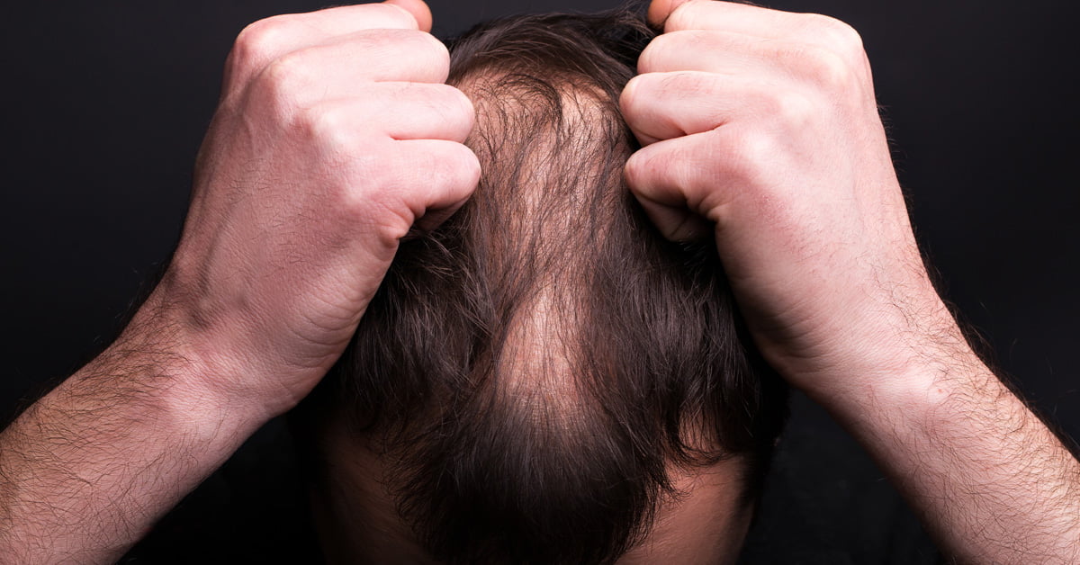 DOES DEPRESSION CAUSE BALDNESS?