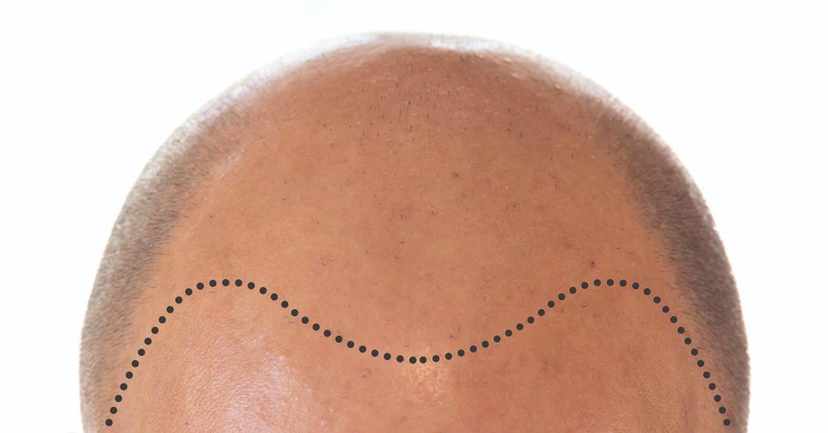 WHAT TO EXPECT DURING A HAIR TRANSPLANT!