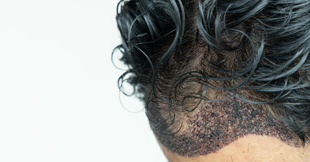 WHAT TO DO AFTER A HAIR TRANSPLANT?