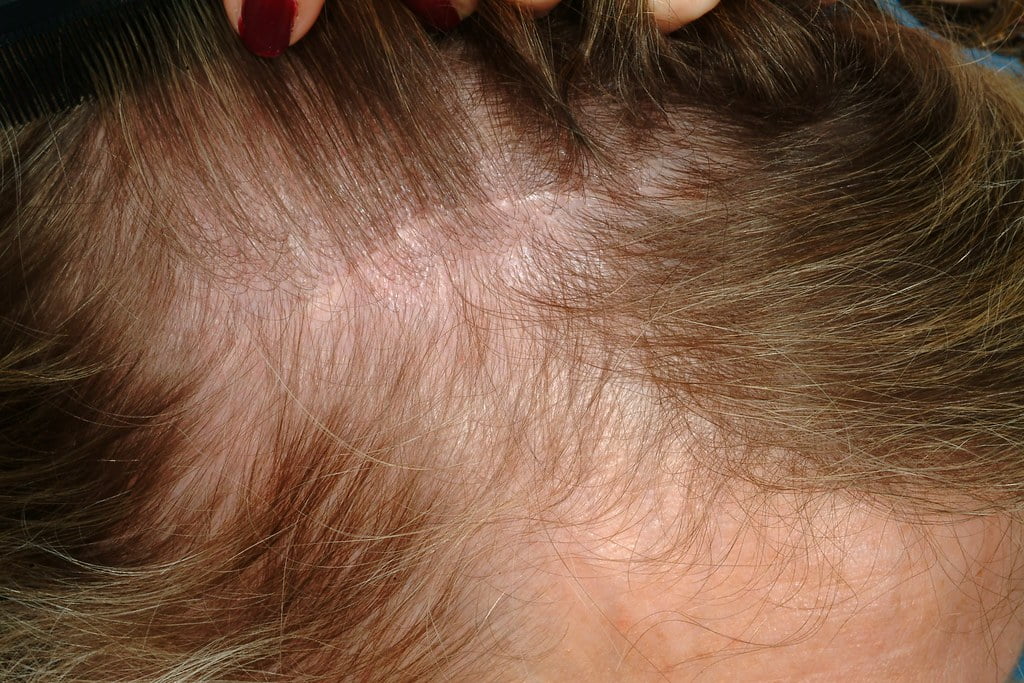 hair transplant hidden scar maxim hair restoration