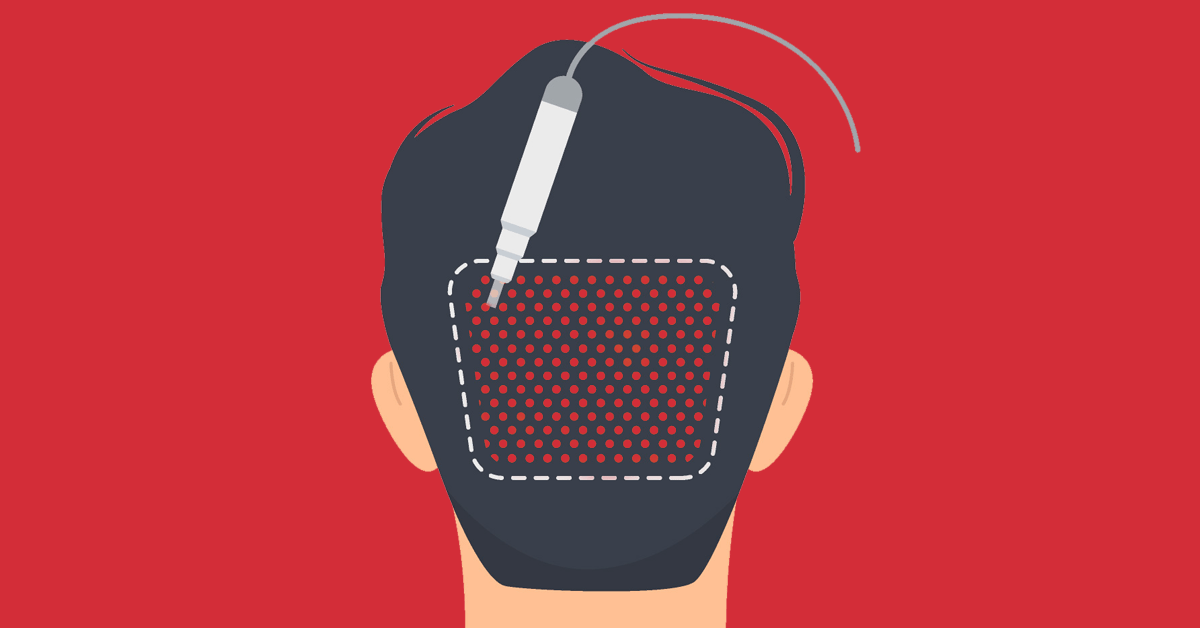 What Does A Hair Transplant Scar Look Like?