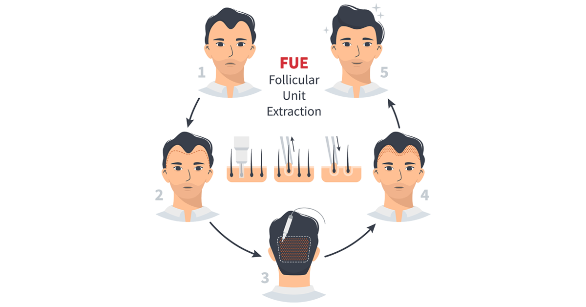 What is a FUE hair transplant?