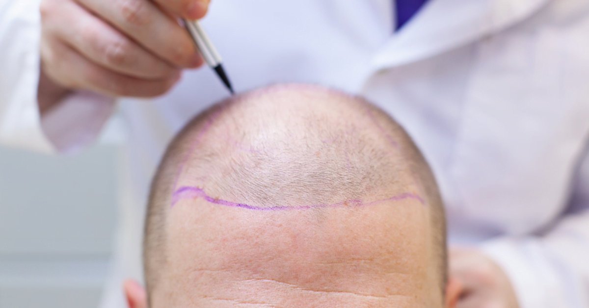 What is a Hair Transplant?