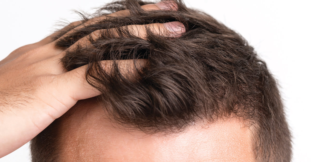 HOW TO CARE FOR TRANSPLANTED HAIR ?