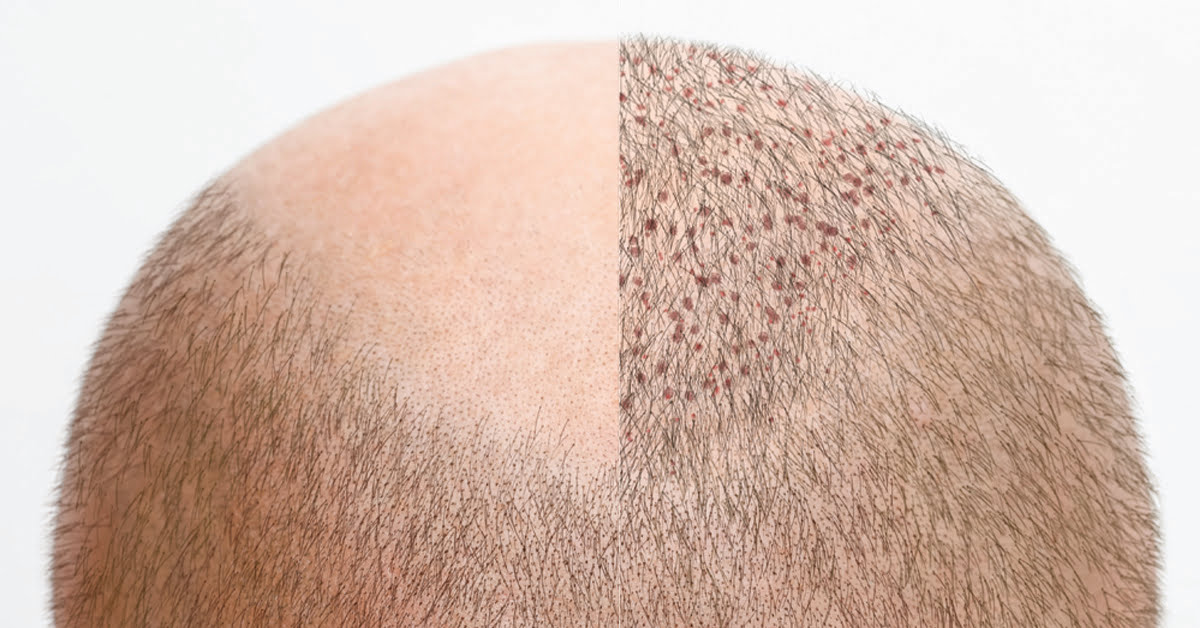 WHAT IS HAIR RESTORATION SURGERY?