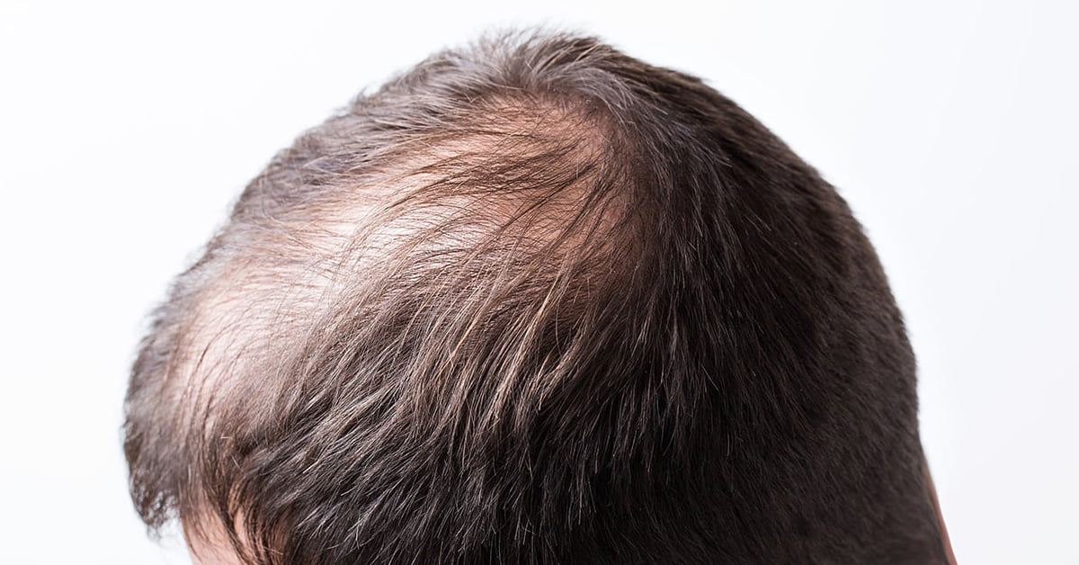 TREATMENT OPTIONS FOR THINNING HAIR