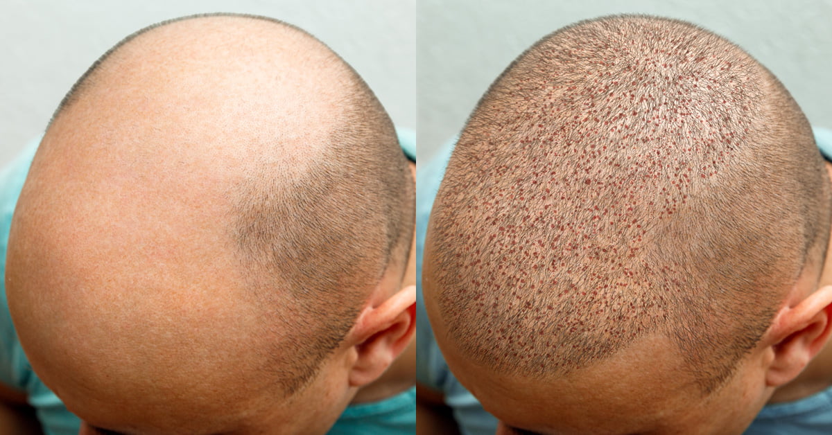 WHAT TO EXPECT FROM A HAIR TRANSPLANT