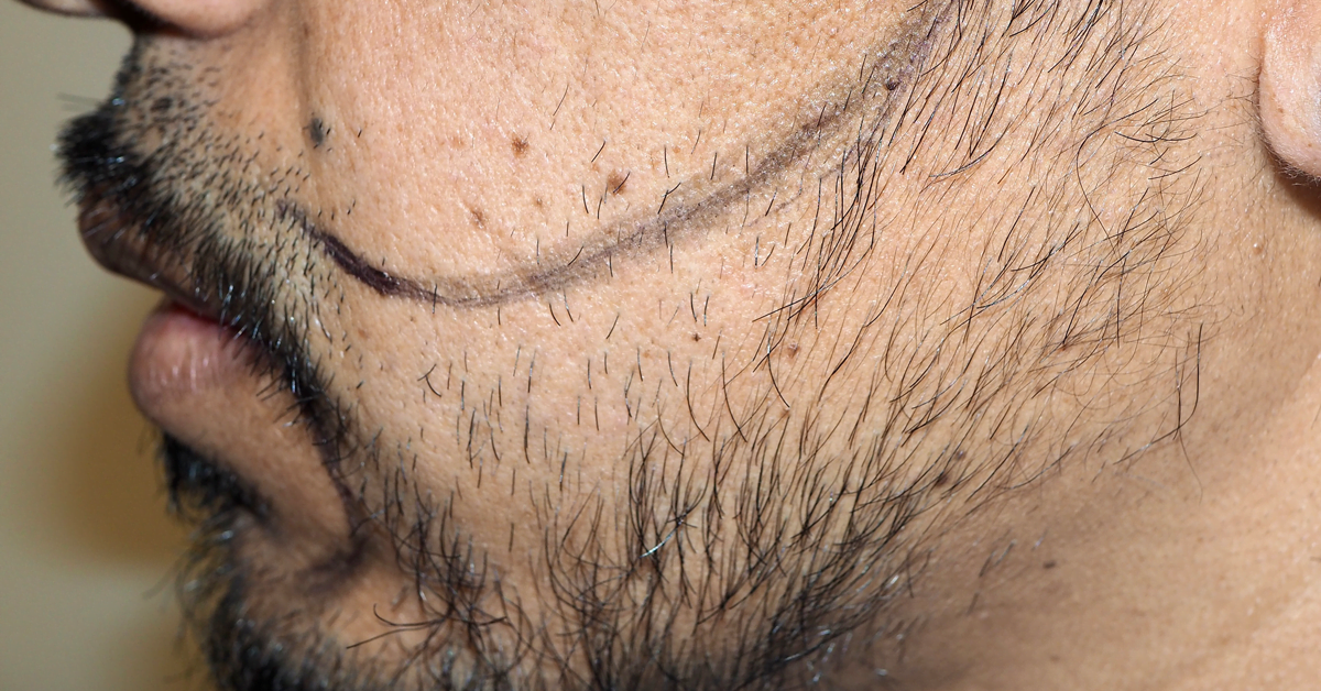 WHAT DOES A FACIAL HAIR TRANSPLANT INVOLVE?