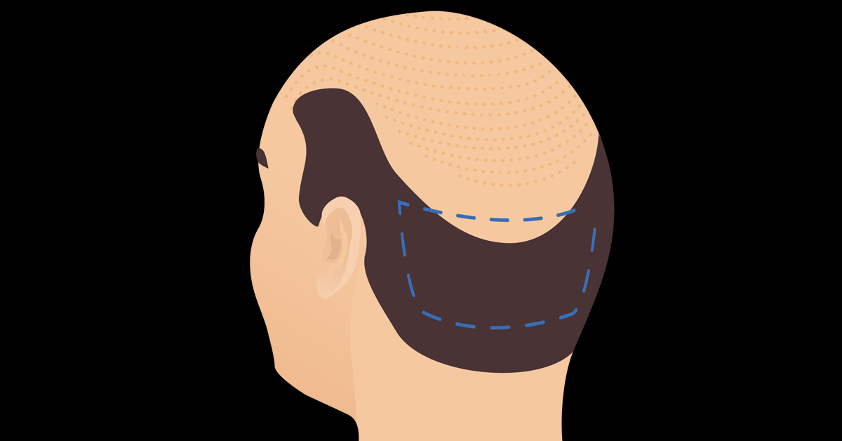 WHAT IS A FUE(FOLLICULAR UNIT EXTRACTION) HAIR TRANSPLANT?
