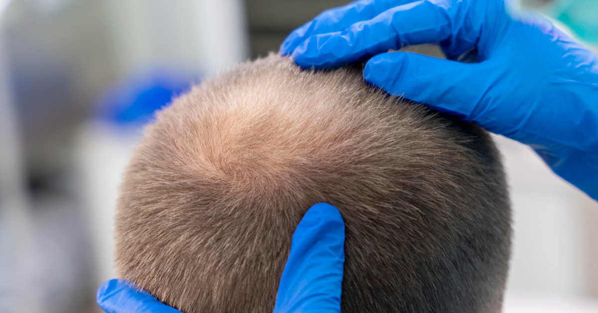 WHAT IS THE UNDERLYING CAUSE OF HAIR LOSS?