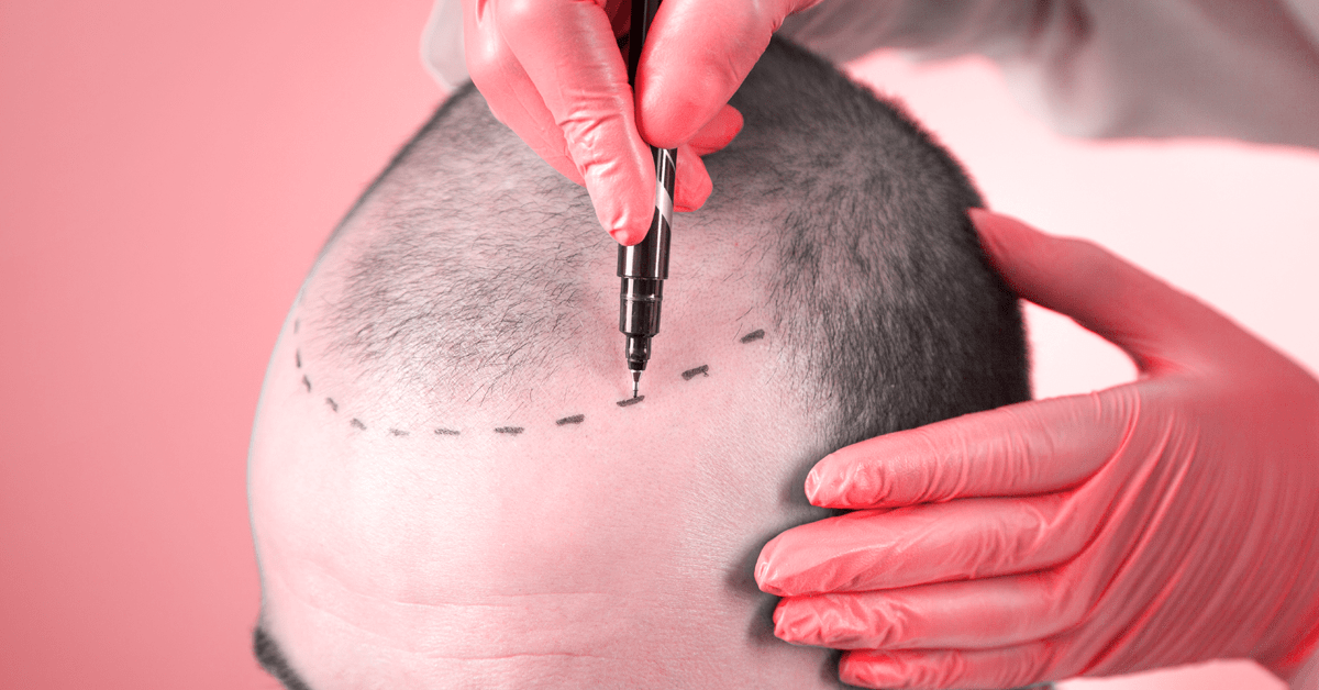 WHAT SHOULD PATIENTS EXPECT BEFORE UNDERGOING A HAIR TRANSPLANT?