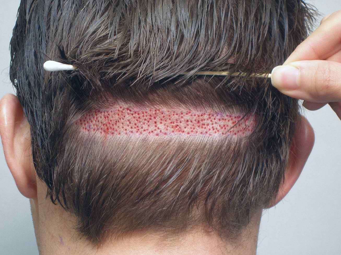 How Many Hair Transplant Grafts Do You Need? | MAXIM Hair Restoration