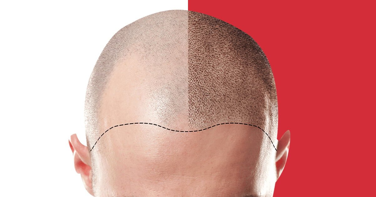 WHAT IS THE PROCESS INVOLVED IN SCALP MICROPIGMENTATION?