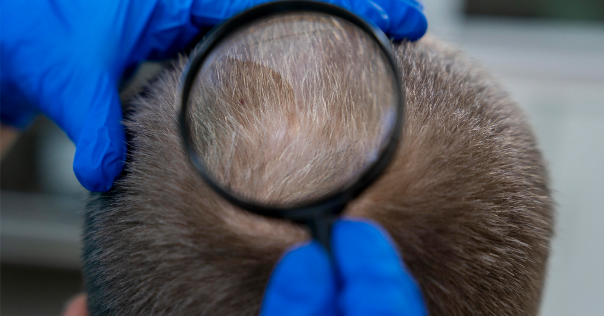 Who is a good candidate for hair transplantation?