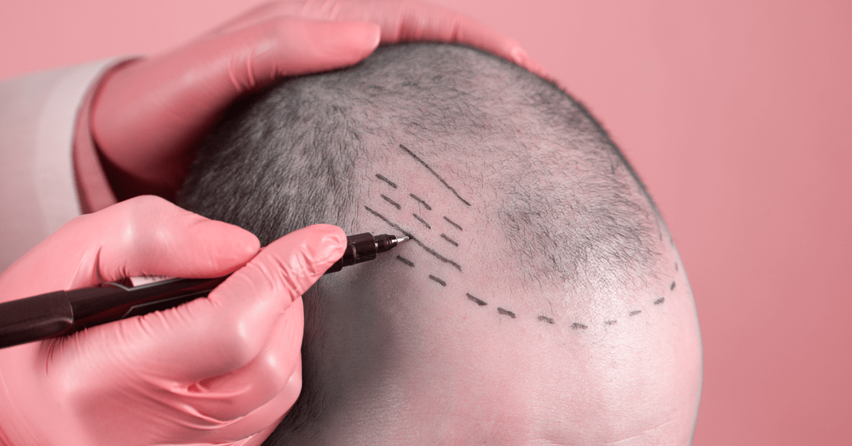 IS IT TIME FOR A HAIR TRANSPLANT?