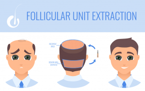 How Are Follicular Units Used In Hair Transplant Surgery?