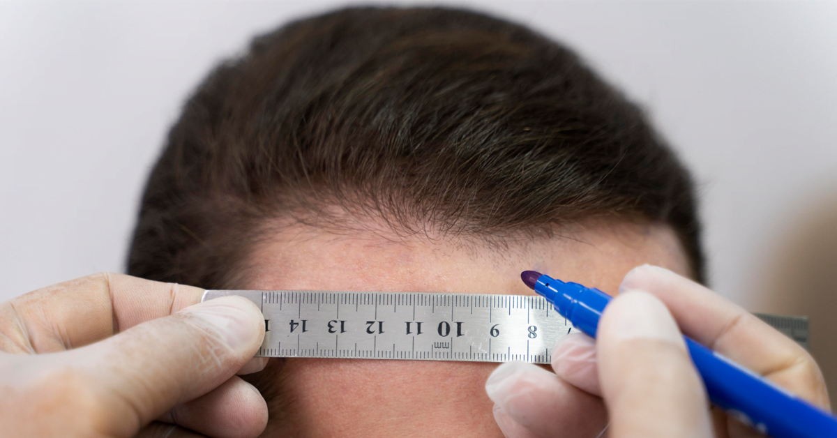 How many grafts are transplanted in an FUE session?