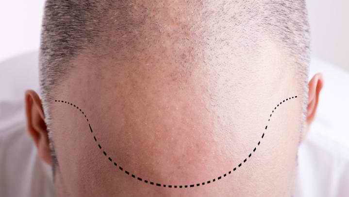 What To Do After A Hair Transplant?