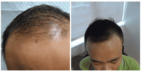Outstanding Results From A Maxim Hair Restoration Manila Client