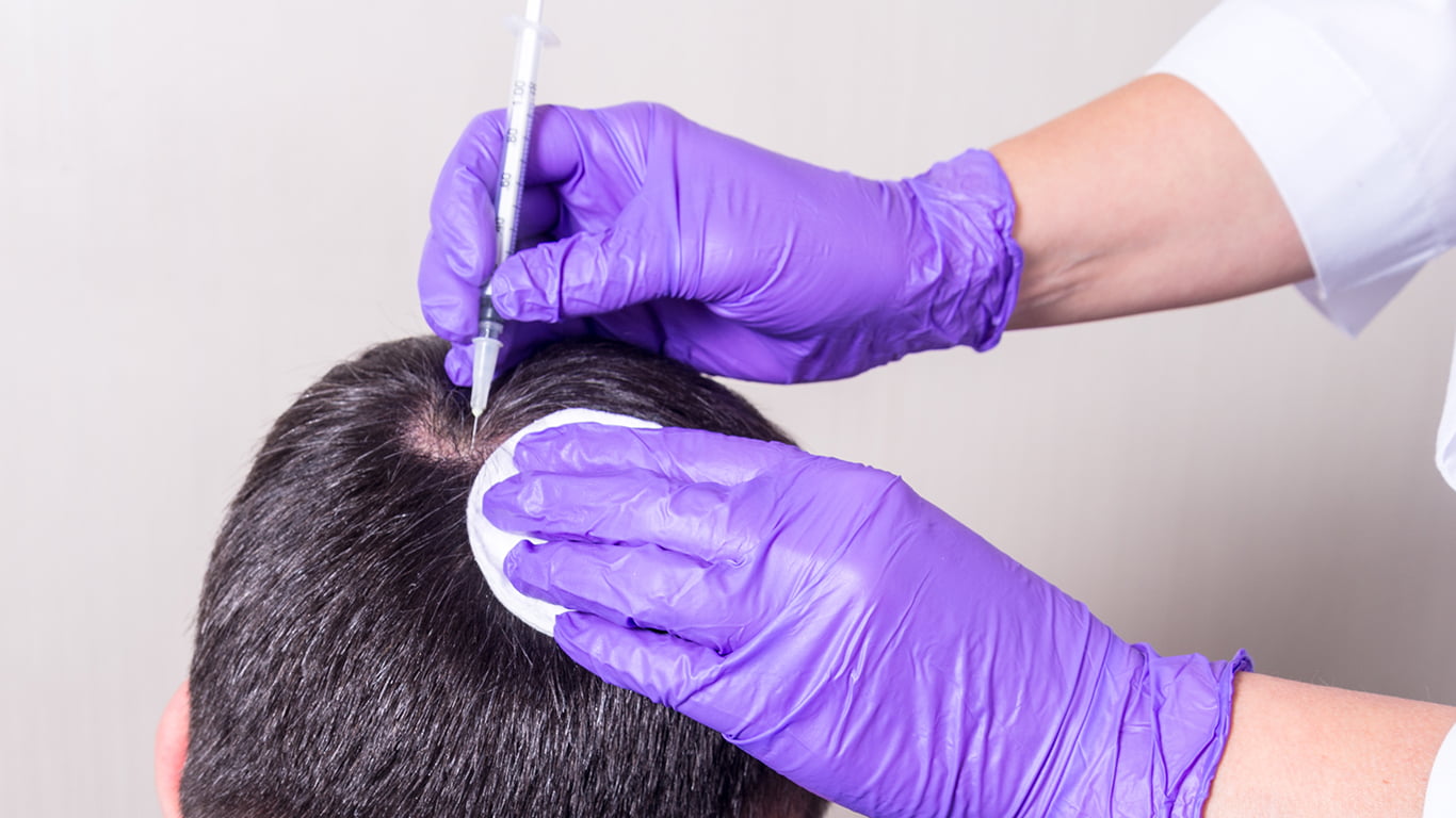 What Is Hair Restoration Surgery?
