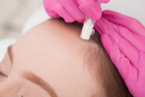 Comparing Non-Invasive Hair Transplant Procedures In Newport Beach, California